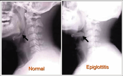 epiglotitis.png